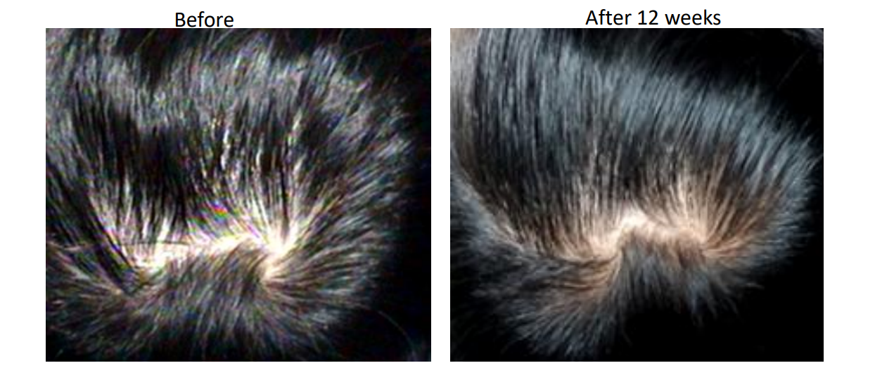 KeraLase laser hair loss treatment